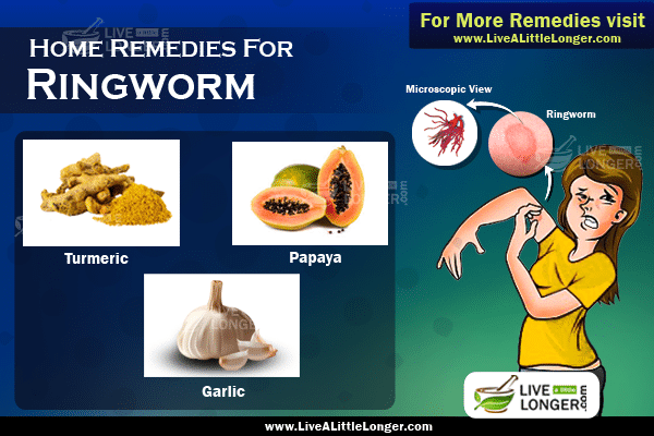 Home remedies for ringworm