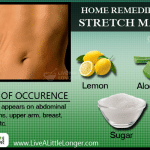 Home remedies for stretch marks