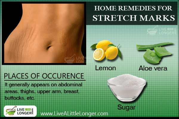 Home remedies for stretch marks