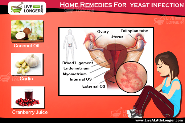 home remedies for yeast infections