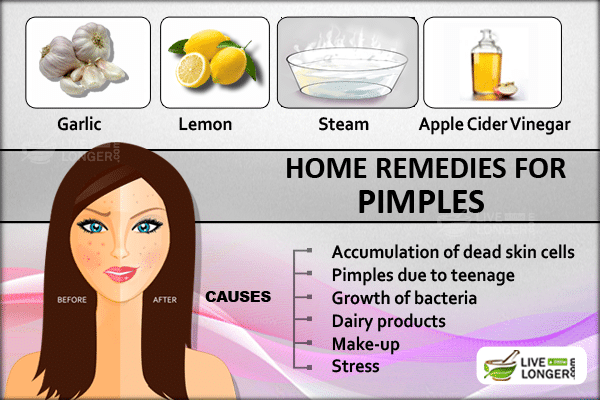 Home remedies for pimples