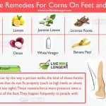 home remedies for corns on feet