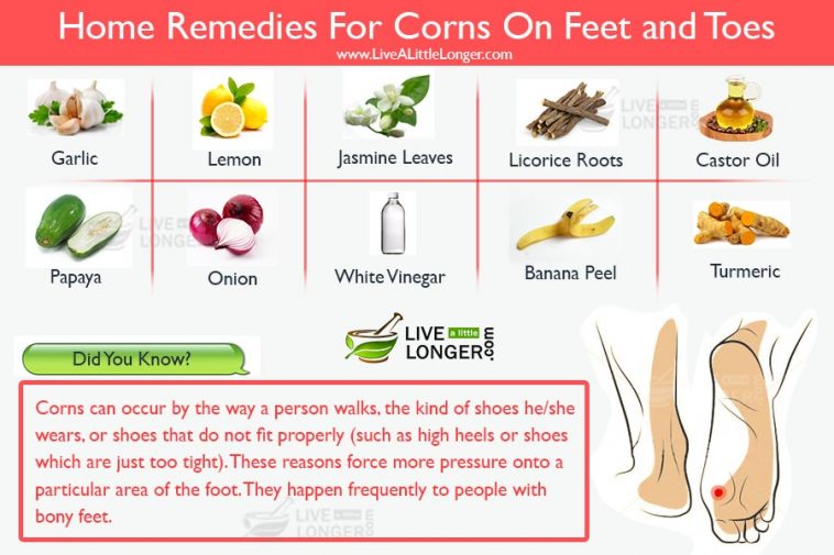 home remedies for corns on feet