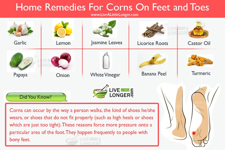 home remedies for corns