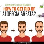 Alopecia-Areata