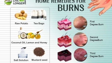 Home remedies for burns