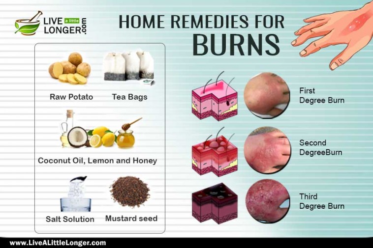 Home remedies for burns