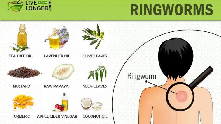 home remedies for ringworms
