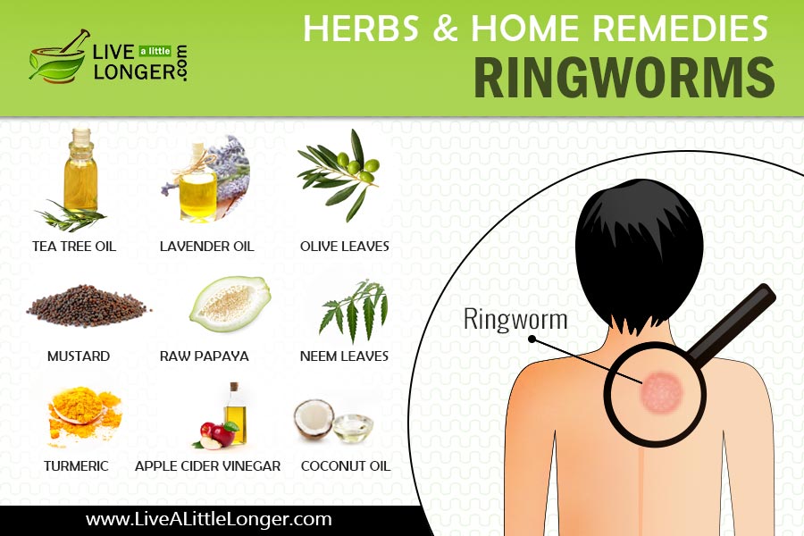 home remedies for ringworms