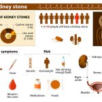 symptoms of kidney stones