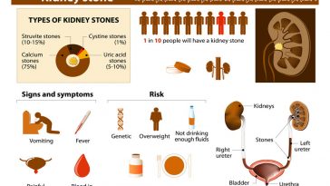 symptoms of kidney stones