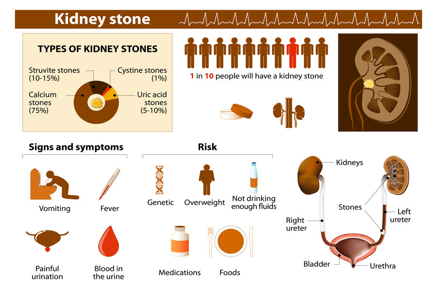 symptoms of kidney stones