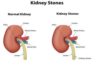 what are kidney stones made of