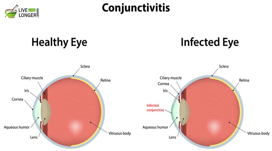 Symptoms of Pink Eye