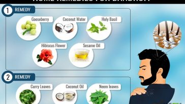 home remedies for dandruff