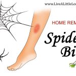 Home Remedies For Spider Bites