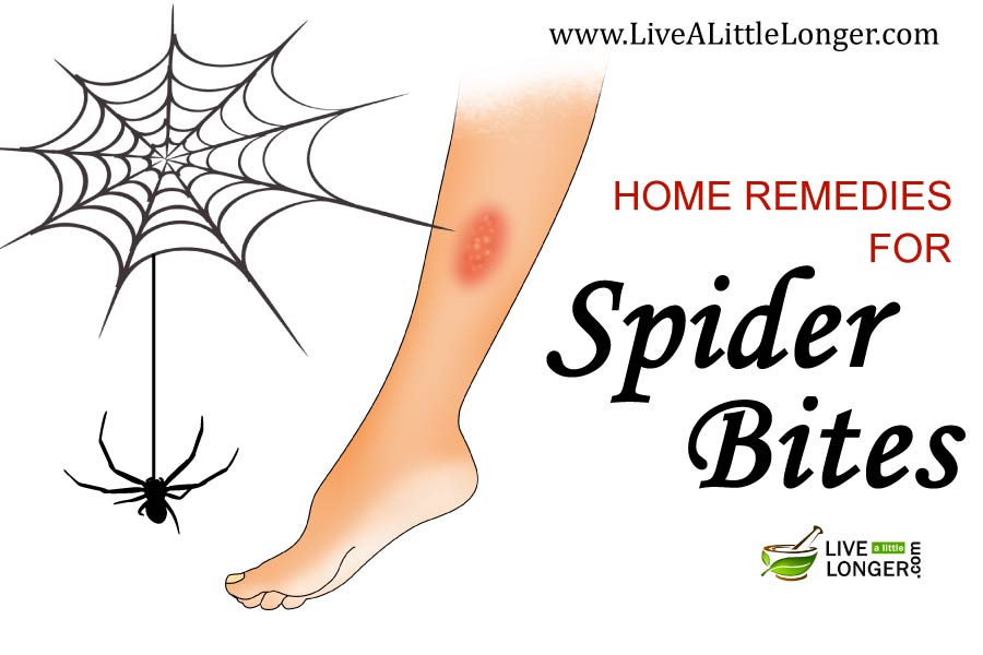 Home Remedies For Spider Bites