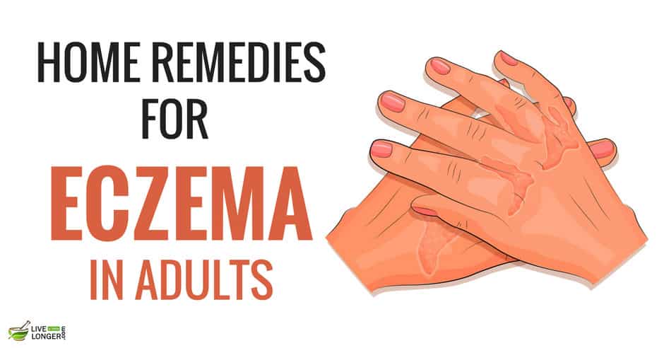 Home Remedies For Eczema In Adults