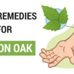 Home Remedies For Poison Oak
