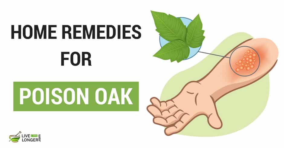 Home Remedies For Poison Oak
