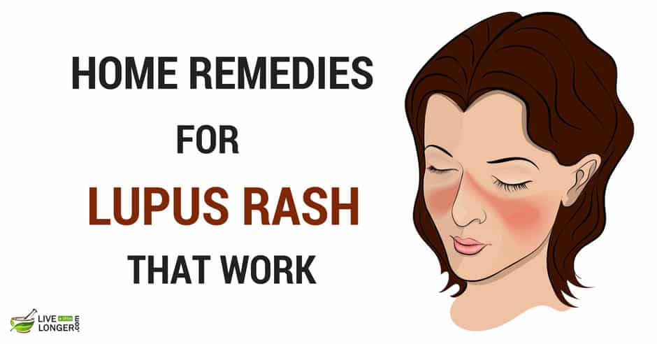 Home Remedies for Lupus Rash