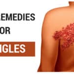 Home Remedies for Shingles