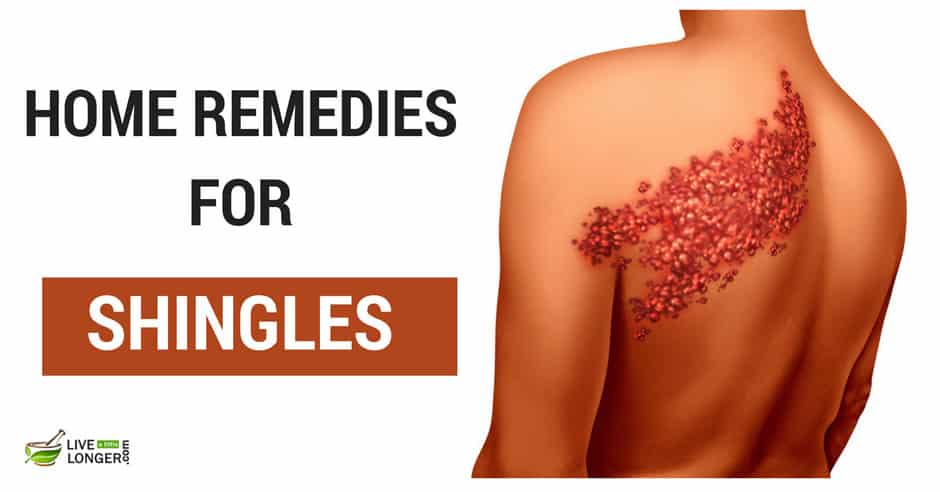 Home Remedies for Shingles