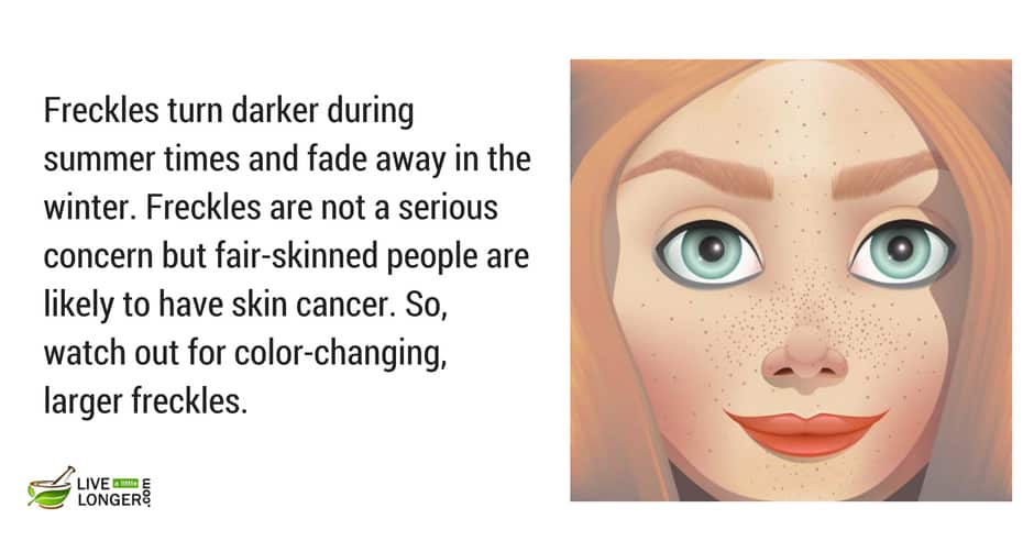 freckle is a common skin disease common illness