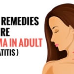 Home Remedies For Eczema In Adults