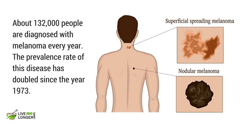 common skin cancers