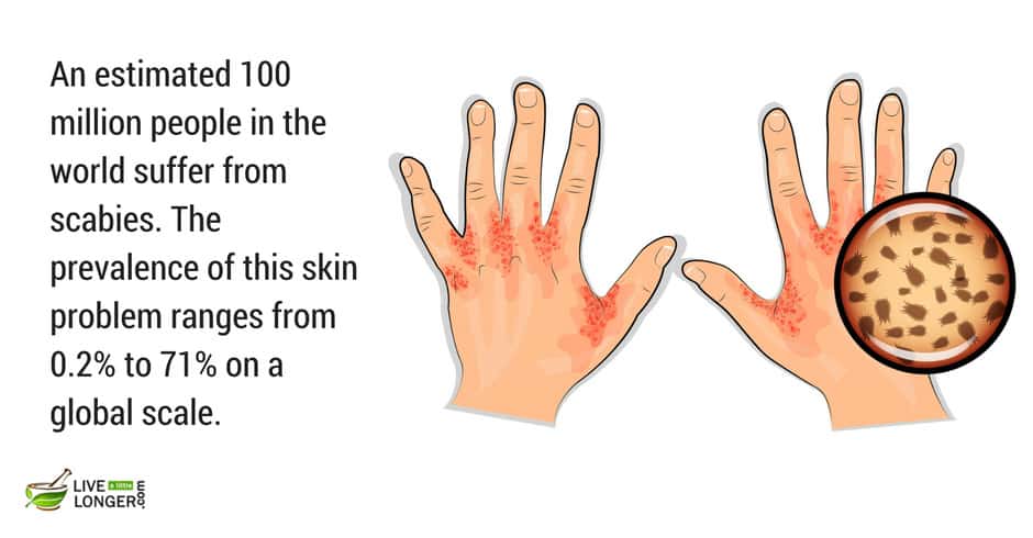 scabies is a common skin disease most-common-skin-diseases