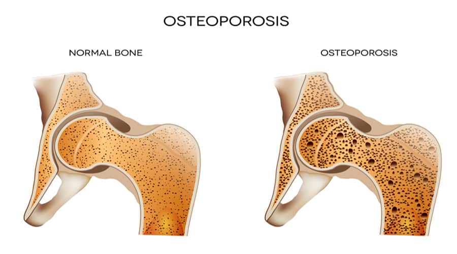 Causes of Osteoporosis