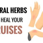 natural remedies for bruises
