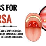 Home Remedies For MRSA