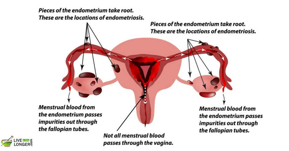 Occurrence of Endometriosis