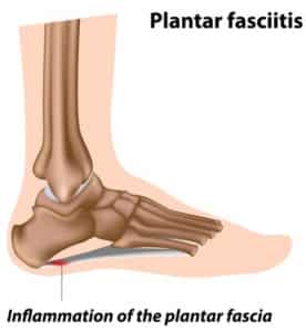 what is Plantar Fasciitis