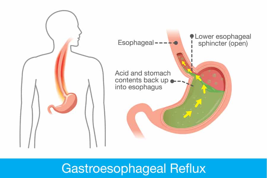 Acid reflux cough home remedies