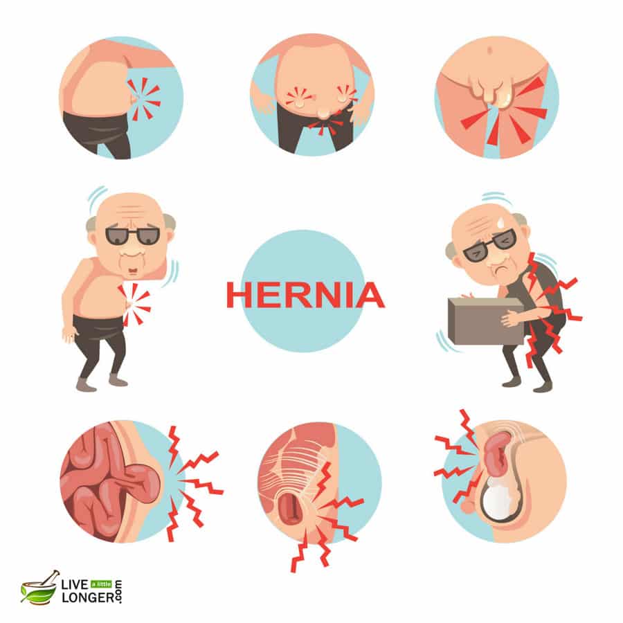 Symptoms of Hernia