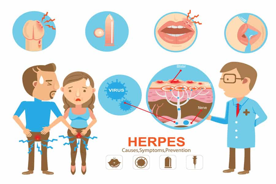 signs and symptoms of herpes