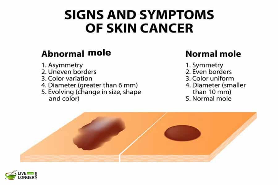 Symptoms of Melanoma