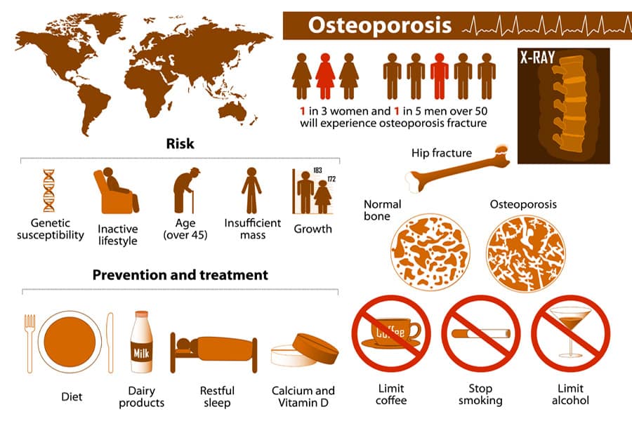 10 Home Remedies For Osteoporosis (Fragile Bones)