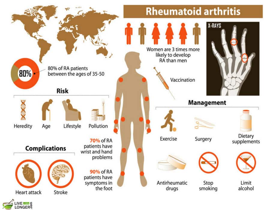 interesting facts about arthritis