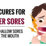 home remedies for canker sores