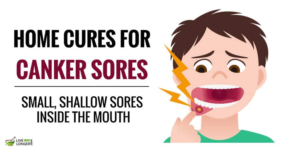 home remedies for canker sores