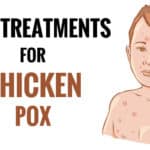 home remedies for chicken pox