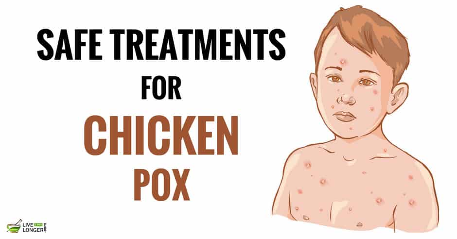 10 Home Remedies For Chickenpox That Have No Side Effects