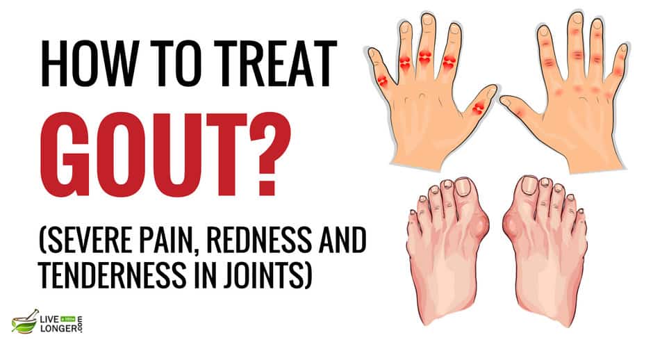 How to treat gout flare up