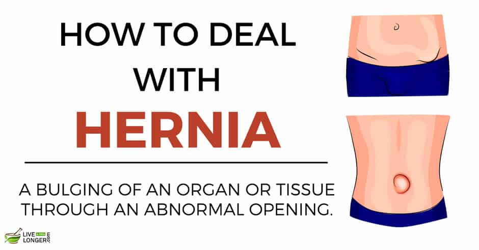 home remedies for hernia