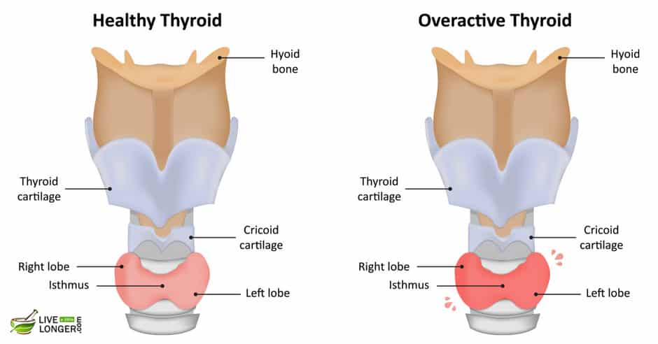 home remedies for overactive thyroid