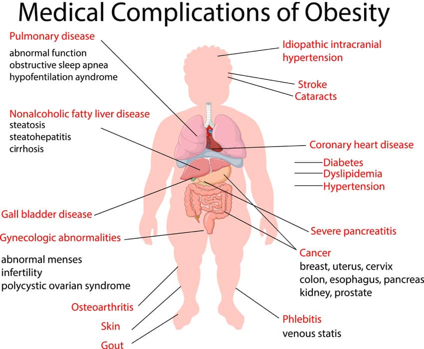 complications of obesity